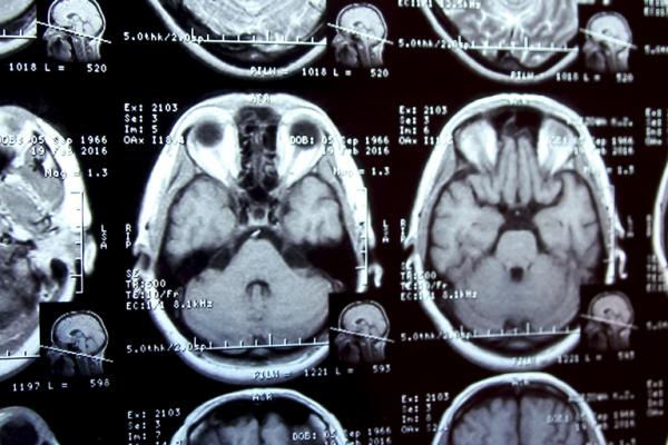 Some brain afflictions are particularly hard to diagnose and have limited treatment options. © alexialex, Shutterstock.com